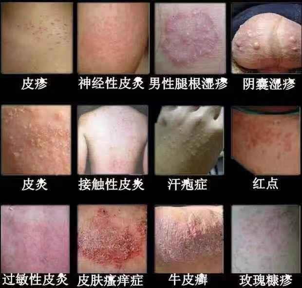 外阴止痒膏女性私处瘙痒阴囊肛门霉菌下面痒白斑膏红霉素软膏潮湿