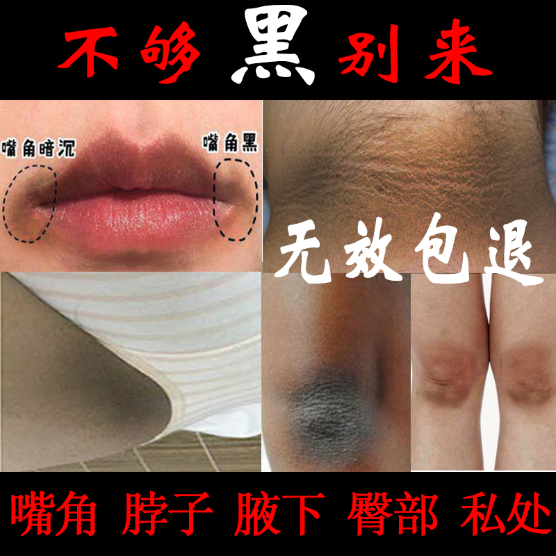 脖子腋窝胳膊肘大腿内侧私处美白屁股臀部坐印去除黑色素嘴角祛黑