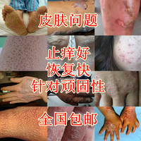 青悠草 牛皮癣藓银屑专用皮肤外用特效药膏头