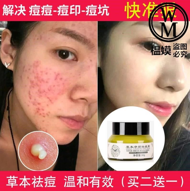 共267 件暗疮克星相关商品