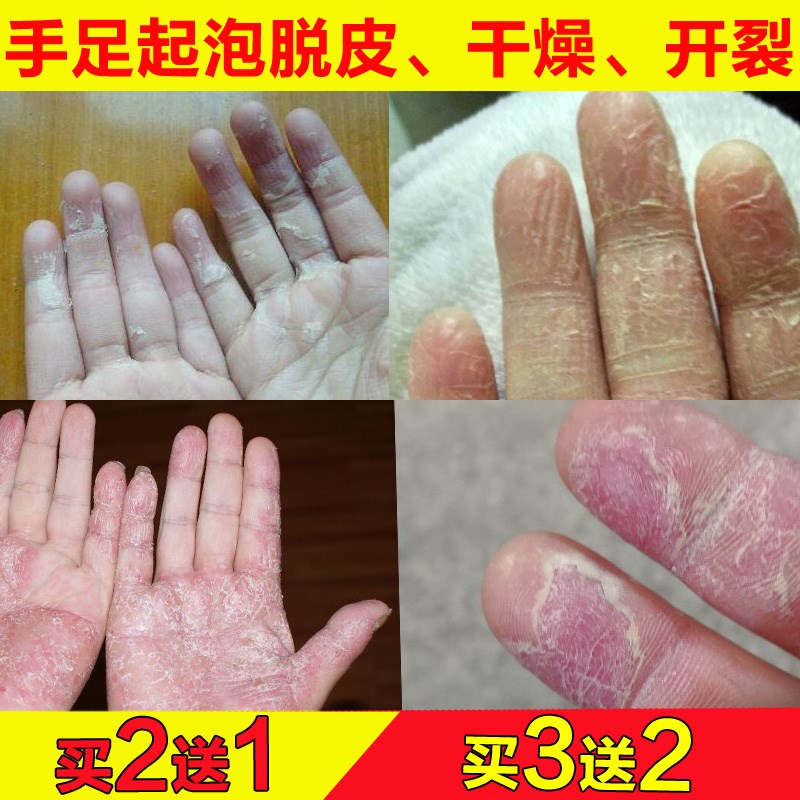 季节性手脱皮的药修复霜手裂口干裂愈合膏儿童手指爆皮脚脱皮起泡