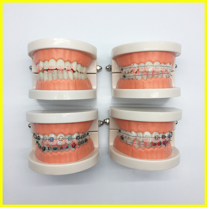 牙科正畸矫正模型口腔科牙齿模型金属托槽颊面管模型医患沟通教学