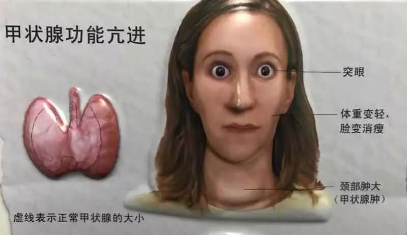 中医甲亢甲状腺结节腺 瘤桥本氏甲状炎 脖子肿大粗突眼贴膏