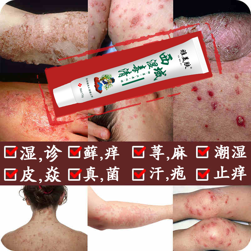 雅美肤湿毒清止痒软膏真菌感染皮肤病大腿内侧瘙痒湿疹过敏性皮炎