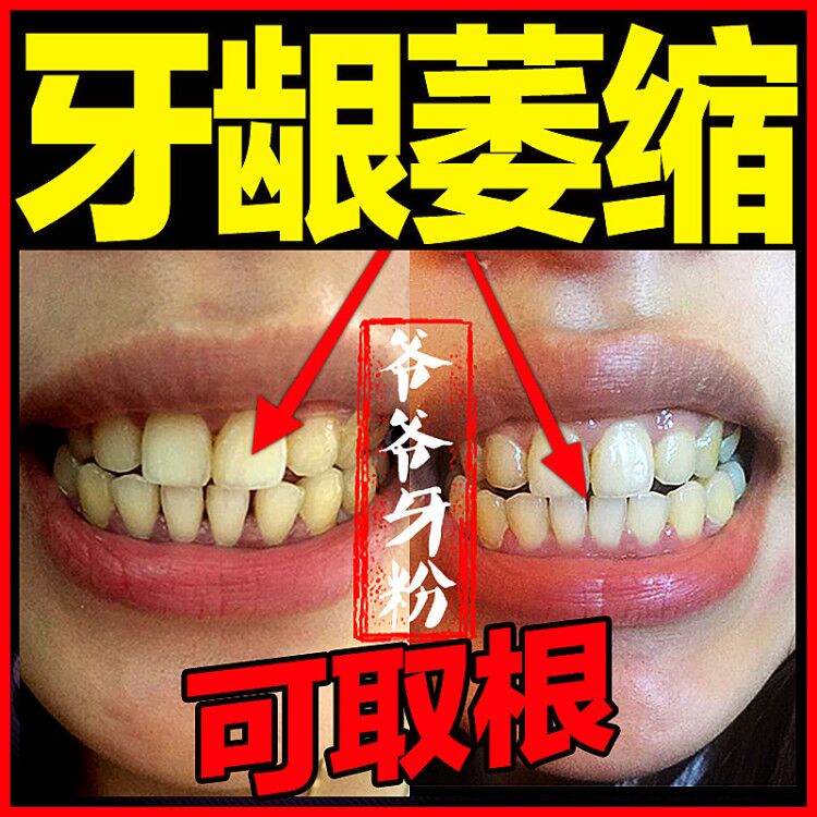 【牙龈萎缩修复】牙缝周出血再生牙齿松动牙结石溶解牙石清除速效