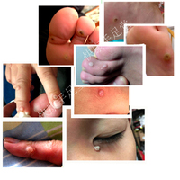 去除跖疣康肉刺瘊子鸡眼膏贴 病毒疣净药膏手